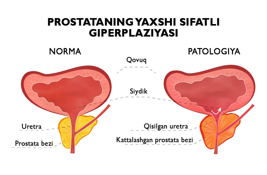 prostata belgilari